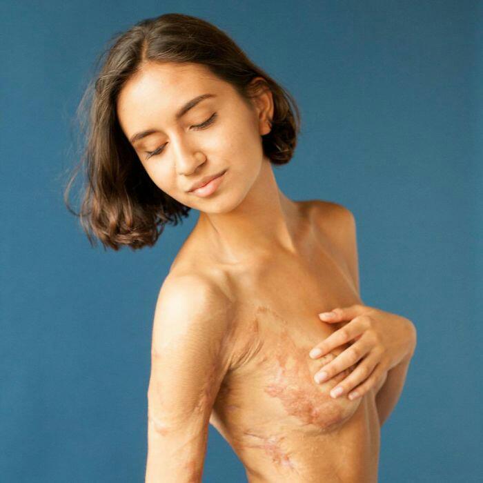 People Shows Their Scars In Powerful Photo Series And Reveals The Story Behind Them